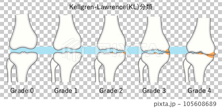 Illustration of the Kellgren Lawrence Classification of Knee Osteoarthritis 105608689