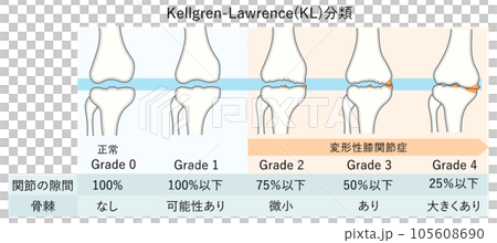Illustration of progression of knee osteoarthritis (KL classification) 105608690