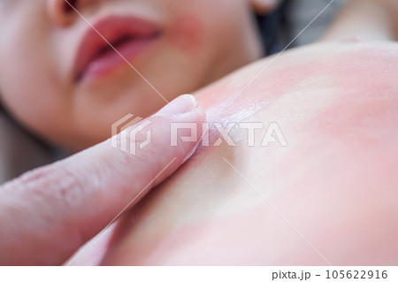 Doctor hand applying topical antihistamine medicine cream on little girl body with severe skin rash and allergy 105622916