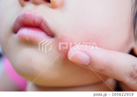 mother applying topical antihistamine cream at kid face with skin rash and allergy with red spot cause by mosquito bite mother applying topical antihistamine cream at kid face with skin rash and allergy with red spot cause by mosquito bite 105622919