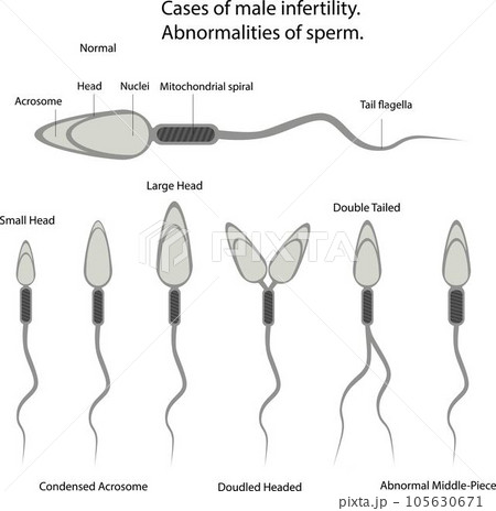 Vector illustration cases of male infertility. Abnormalities of sperm. 105630671