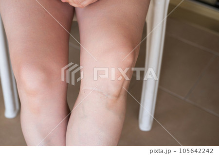 Scar on a girl's leg close-up. Varicose veins from the injury on the leg Scar on a girl's leg close-up. Varicose veins from the injury on the leg 105642242