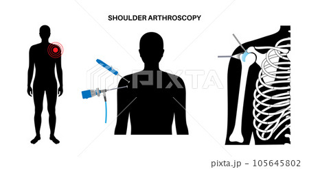 Shoulder arthroscopy poster 105645802