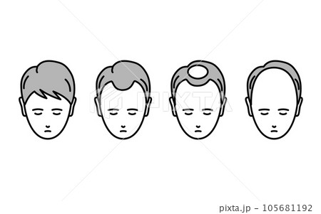 AGA、脱毛症が進行する男性のイラスト AGA、脱毛症が進行する男性のイラスト 105681192