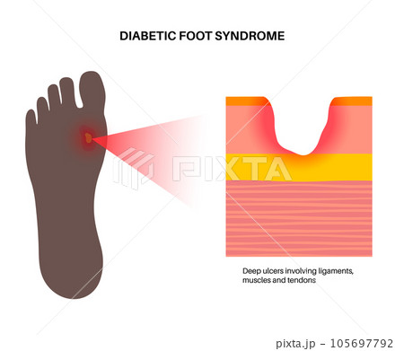 Diabetic Foot Ulcers 105697792