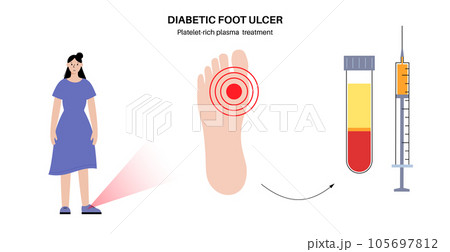 Diabetic Foot Ulcers Diabetic Foot Ulcers 105697812