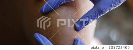 Doctor in latex gloves checkup unhealthy skin of male patient. Doctor in latex gloves checkup unhealthy skin of male patient. 105722409
