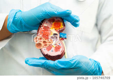 Kidney disease, Chronic kidney disease ckd, Doctor hold model to study and treat in hospital. 105740709