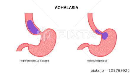 Esophageal achalasia disease Esophageal achalasia disease 105768926
