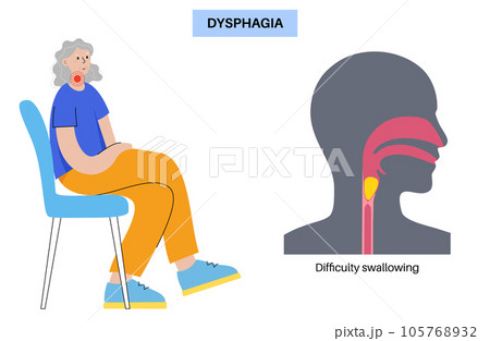 Esophageal achalasia disease Esophageal achalasia disease 105768932