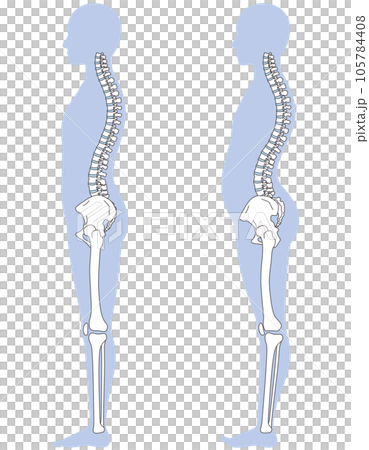 反り腰の姿勢　比較 105784408
