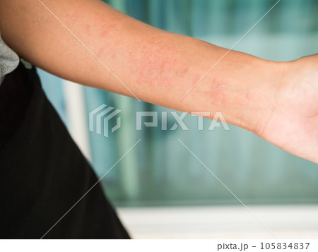 Hand woman non-lethal type from food and air poisoning. she apply Calamine Lotion medicine on the arm her.she Sick, have an allergic reaction. Urticaria on skin body.healthcare concept. 105834837