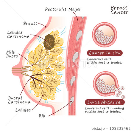 Breast cancer・IDC・ILC・DCIS・LCIS・illustration・乳癌 105835463