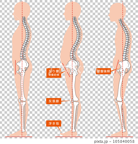 反り腰、骨盤後傾の姿勢　比較 105840058