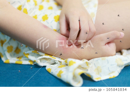 Little girl has skin rash allergy and itchy on her arm from mosquito bite Little girl has skin rash allergy and itchy on her arm from mosquito bite 105841034