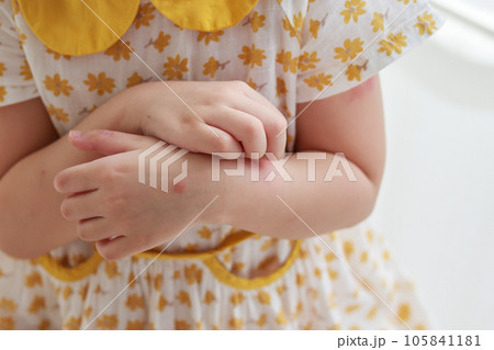 Little girl has skin rash allergy itching and scratching on her arm 105841181