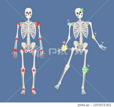 Recovery from autoimmune disease, healthy joints. Human skeleton with pain points in rheumatoid arthritis. Men anatomy illustration with a body silhouette 105853162