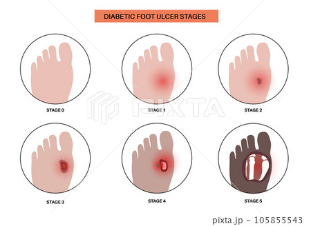 Diabetic Foot Ulcers Diabetic Foot Ulcers 105855543