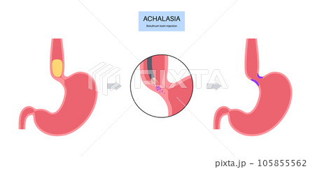 esophageal botulinum toxin injection 105855562