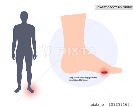Diabetic Foot Ulcers 105855565