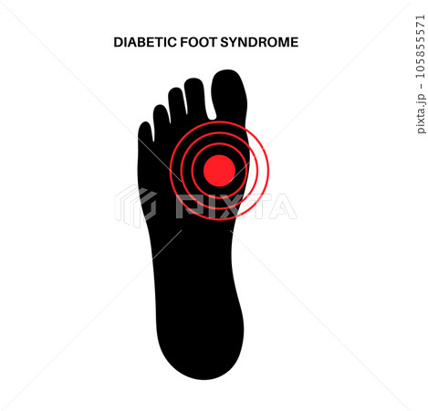 Diabetic Foot Ulcers 105855571