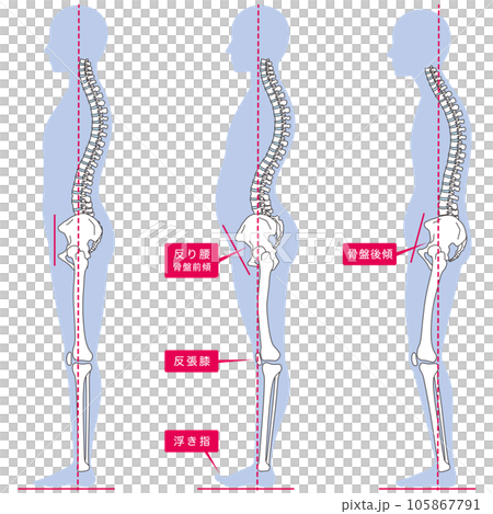 Posture comparison of arched back and posterior tilt of the pelvis Posture comparison of arched back and posterior tilt of the pelvis 105867791
