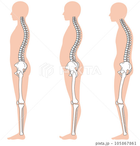反り腰、骨盤後傾の姿勢 比較 反り腰、骨盤後傾の姿勢 比較 105867861