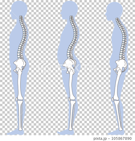 Posture comparison of arched back and posterior tilt of the pelvis Posture comparison of arched back and posterior tilt of the pelvis 105867890