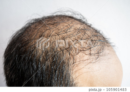 Side view of baldness men's head with thin hair on his top and forehead. Conceptual of hair problem on men's head. Side view of baldness men's head with thin hair on his top and forehead. Conceptual of hair problem on men's head. 105901483