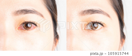 Before and after treatment red eye. Cause of red eye include conjunctivits, bacterial infection, dry eye, eye injury, allergies and over wearing contact lenses. Before and after treatment red eye. Cause of red eye include conjunctivits, bacterial infection, dry eye, eye injury, allergies and over wearing contact lenses. 105915744