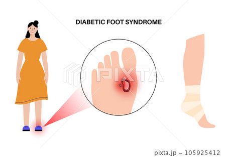 Diabetic Foot Ulcers 105925412