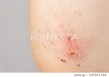 Healing abrasion on the elbow of a small child, the formation of a crust on the skin 105941788