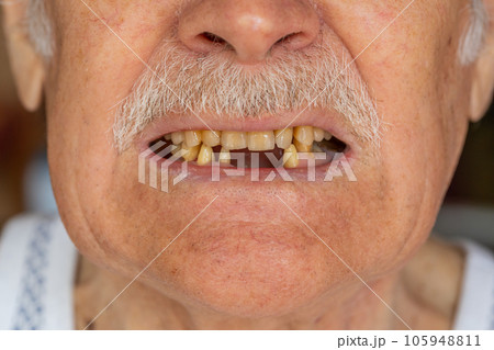 Toothless male smile mouth of senior elderly old man, dental problem, bad rotten teeth loss, caries 105948811
