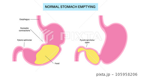 Gastroparesis anatomical poster Gastroparesis anatomical poster 105958206