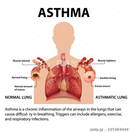 Comparing Normal and Asthma Lungs: An Educational Infographic 105969494