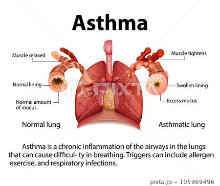 Comparing Normal and Asthma Lungs in Medical Education 105969496