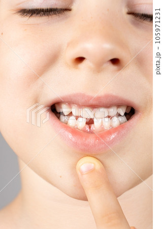 Loss of milk teeth in children. A six-year-old child shows the first baby tooth that has fallen out 105971231