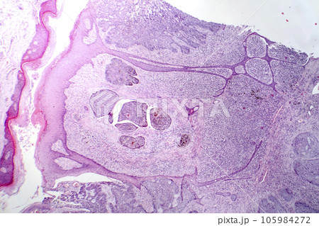 Basal cell carcinoma, light micrograph Basal cell carcinoma, light micrograph 105984272