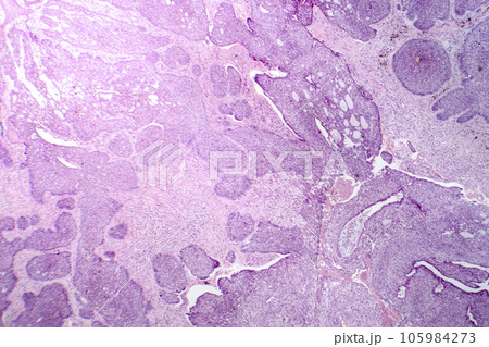 Basal cell carcinoma, light micrograph Basal cell carcinoma, light micrograph 105984273
