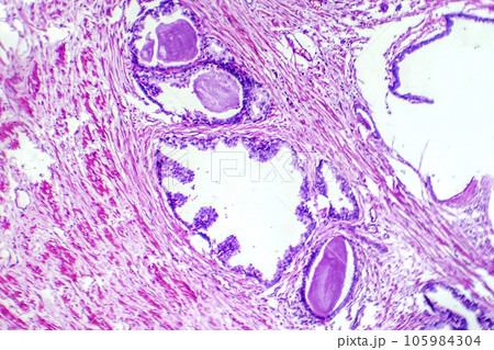 Micrograph of prostatic hyperplasia 105984304