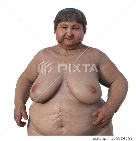 A woman with overweight body composition, 3D medical illustration A woman with overweight body composition, 3D medical illustration 105984355