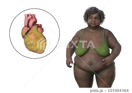 An obese woman with ascending aortic aneurysm, 3D illustration 105984368