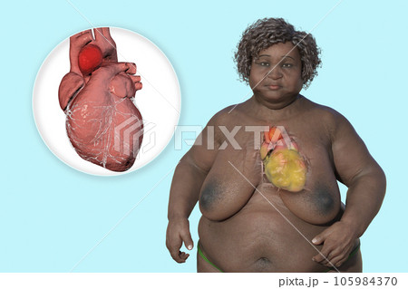 An obese woman with ascending aortic aneurysm, 3D illustration 105984370