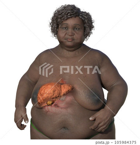 An overweight woman with liver steatosis, 3D illustration. 105984375
