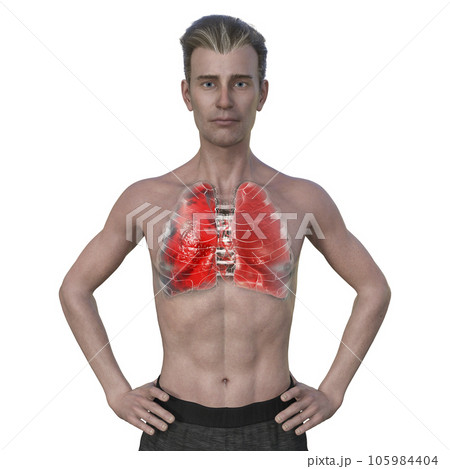 A 3D illustration of a man with the lungs affected by pneumonia 105984404