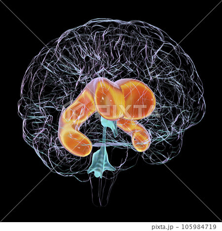 Enlarged lateral ventricles of the brain, 3D illustration Enlarged lateral ventricles of the brain, 3D illustration 105984719