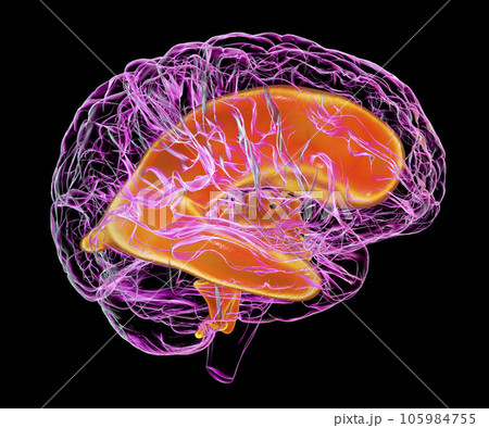 Enlarged ventricles of the child brain, 3D illustration Enlarged ventricles of the child brain, 3D illustration 105984755