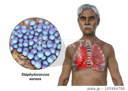 A 3D illustration showcasing the upper half part of a man with transparent skin, revealing the lungs affected by pneumonia A 3D illustration showcasing the upper half part of a man with transparent skin, revealing the lungs affected by pneumonia 105984780