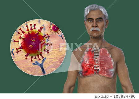 A 3D illustration showcasing the upper half part of a man with transparent skin, revealing the lungs affected by Covid-19 pneumonia A 3D illustration showcasing the upper half part of a man with transparent skin, revealing the lungs affected by Covid-19 pneumonia 105984790
