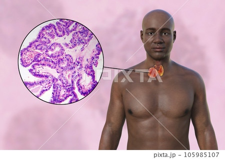 Thyroid cancer, 3D illustration 105985107